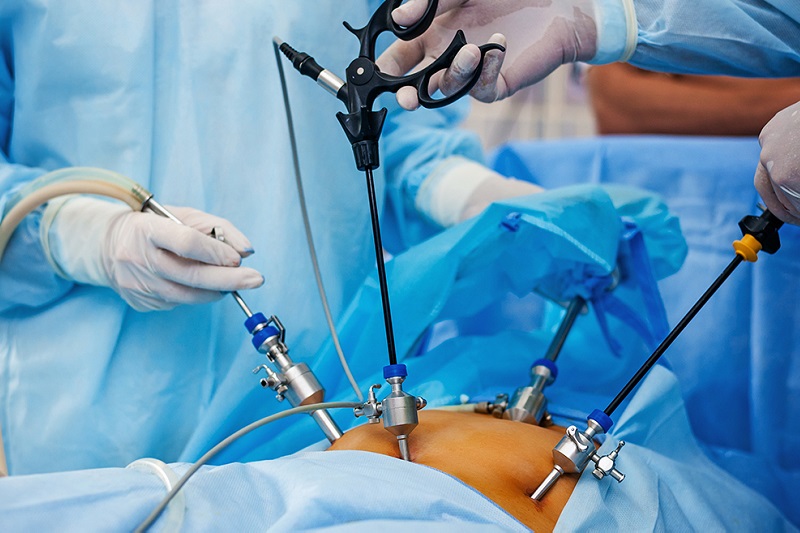 Gynecological Laparoscopic Surgeries
