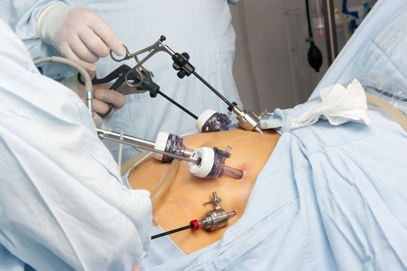 Laparoscopic Fibroid Removal
